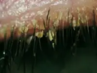 Blepharitis